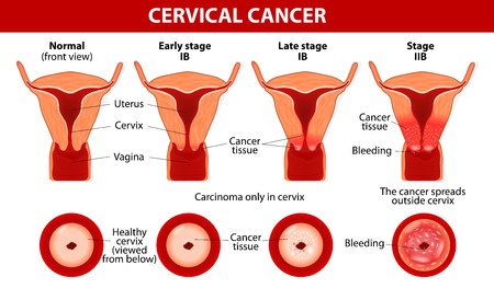 Stages of cervical cancer
